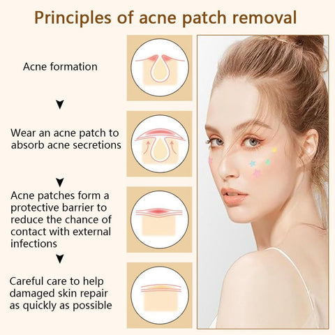 Pimple Patches, Pimple Patches for Face, Acne Treatment for Face, Acne Pimple Patch for Covering Zits and Blemishes, Spot Stickers for Face and Skin