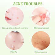 Pimple Patches, Pimple Patches for Face, Acne Treatment for Face, Acne Pimple Patch for Covering Zits and Blemishes, Spot Stickers for Face and Skin